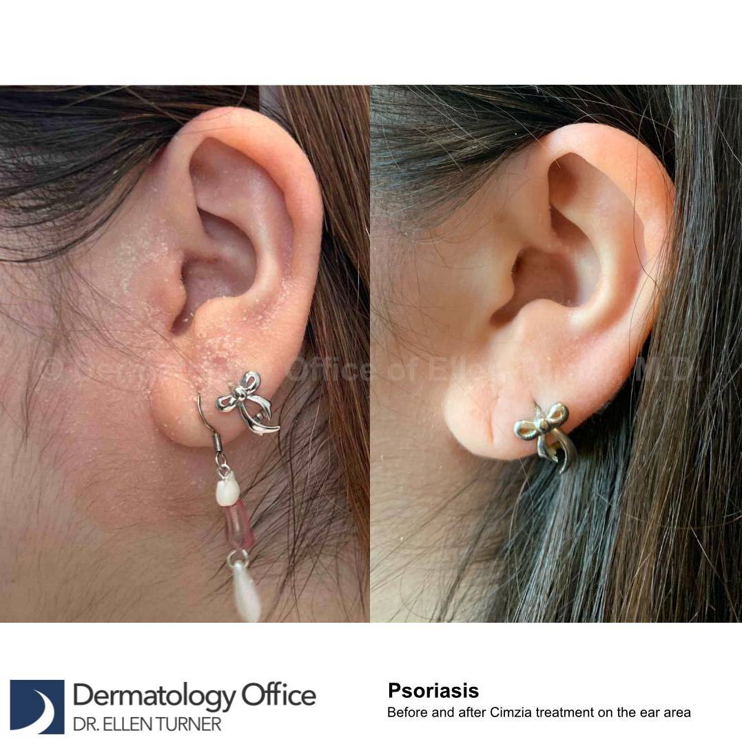 Psoriasis Before and After Case 60 