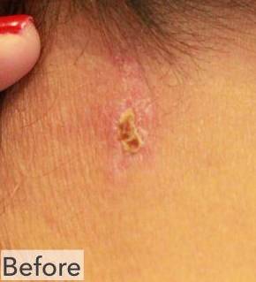 Shingles Before and After Case 3 Before