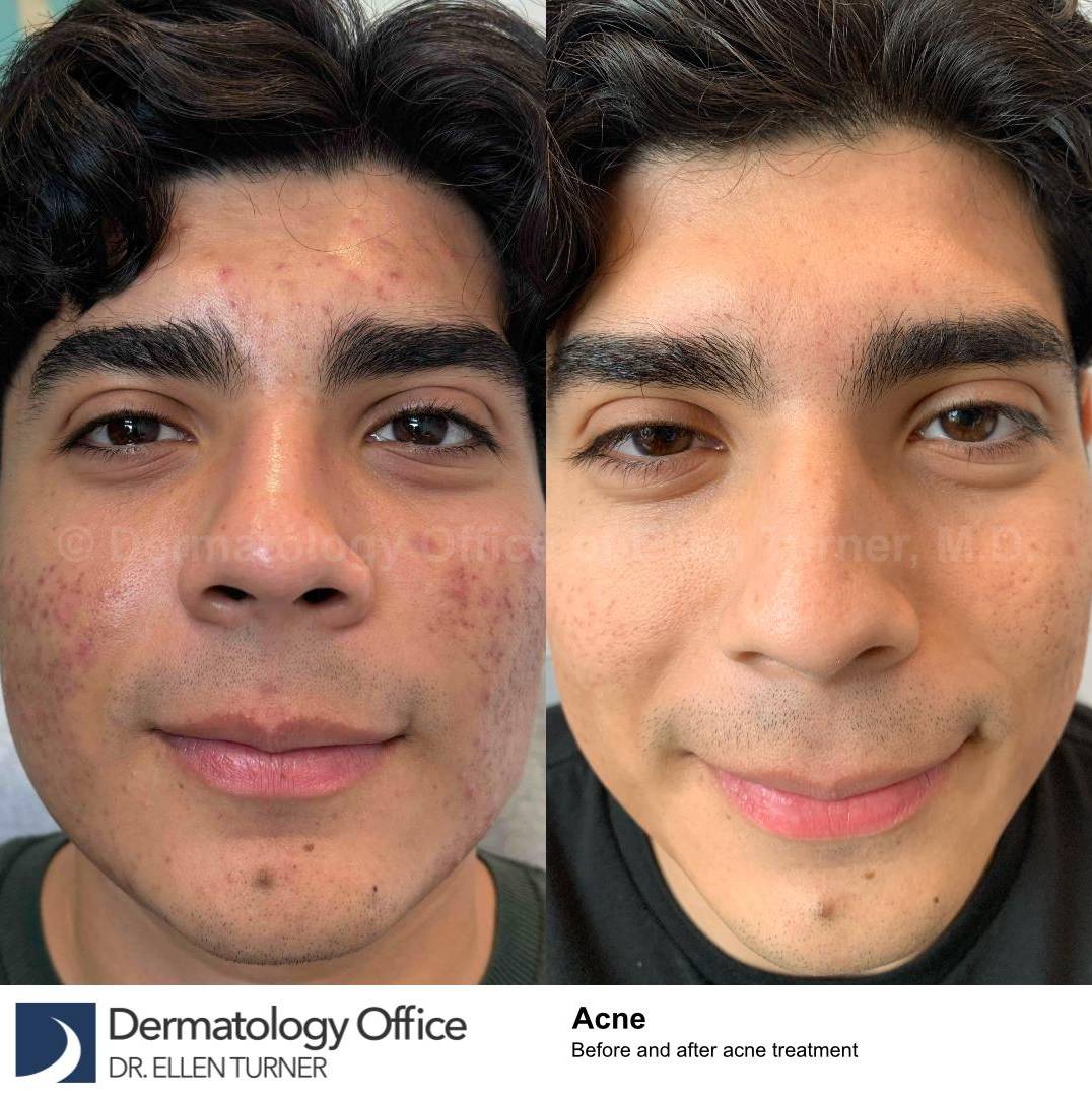 Acne Before and After Case-26 