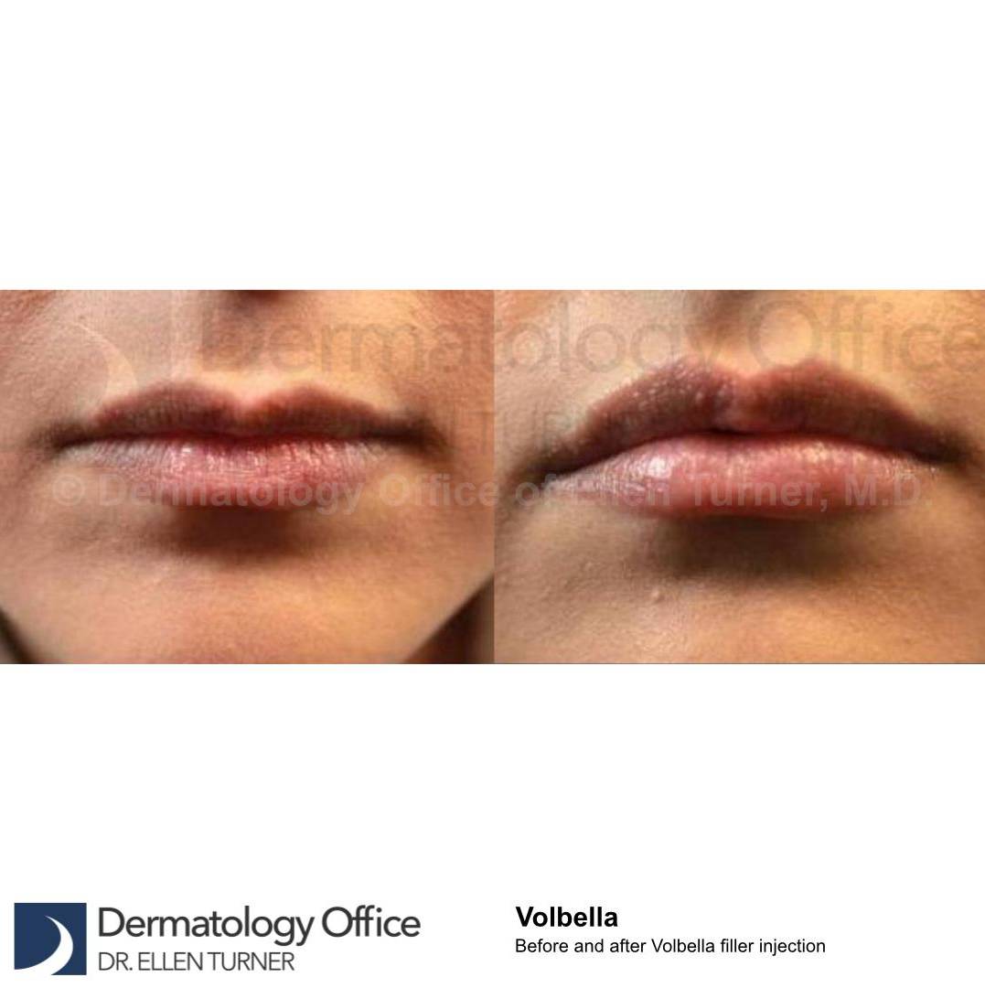 Volbella (2 Syringes) Case 1 