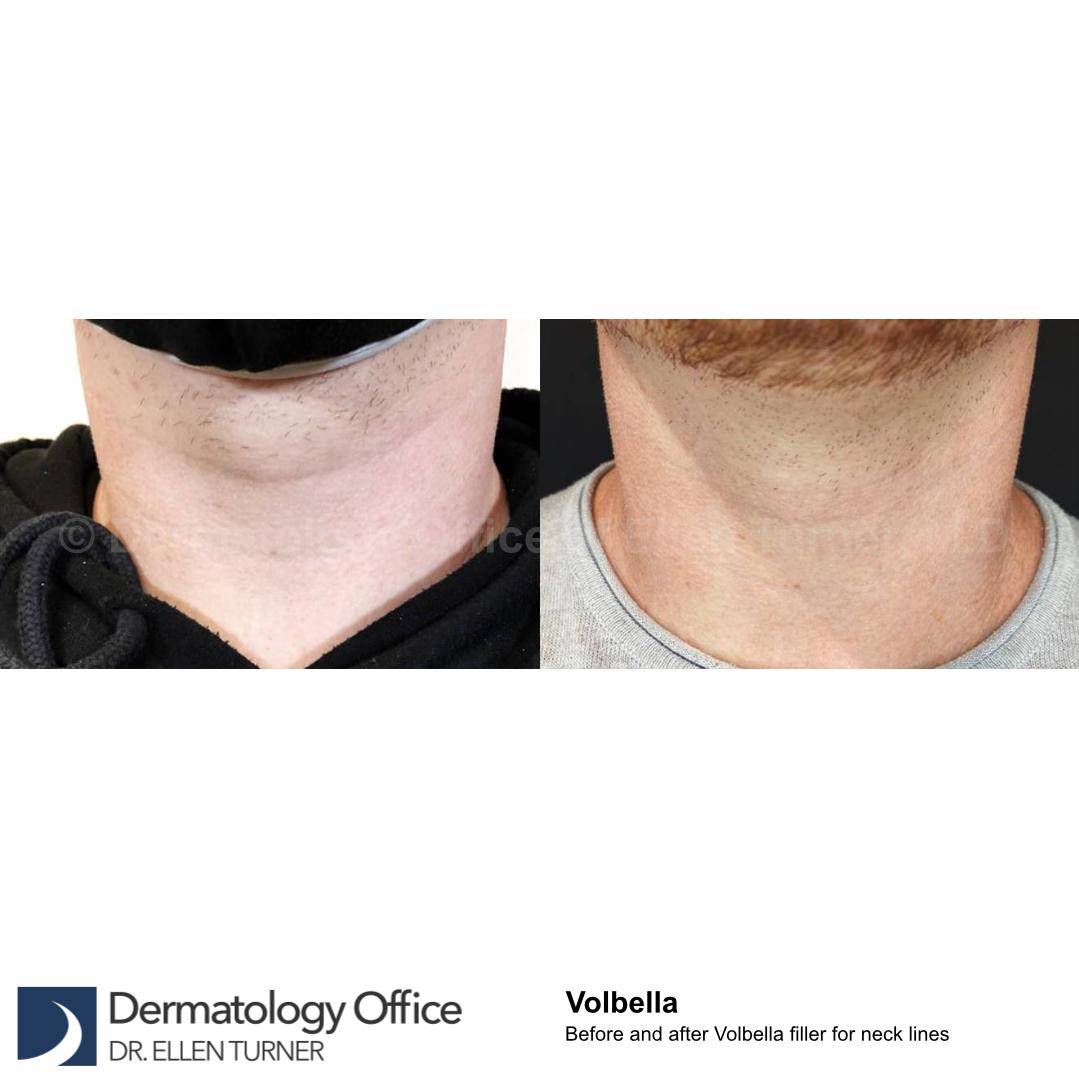 Volbella (2 syringes) Before and After Case 5 
