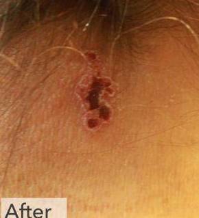 Shingles Before and After Case 3 After
