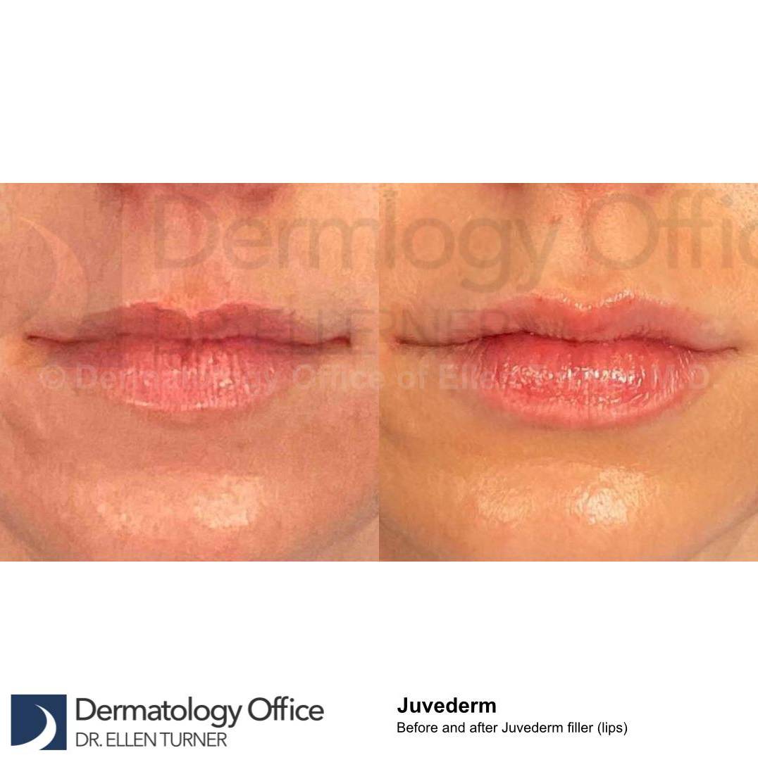 Juvederm (1 Syringe) Case-20 