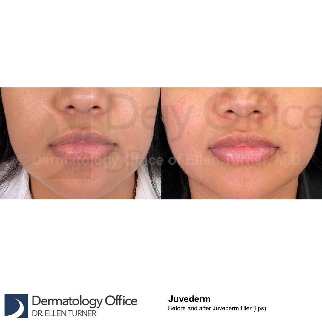 Juvederm (1 Syringe) Case-24 