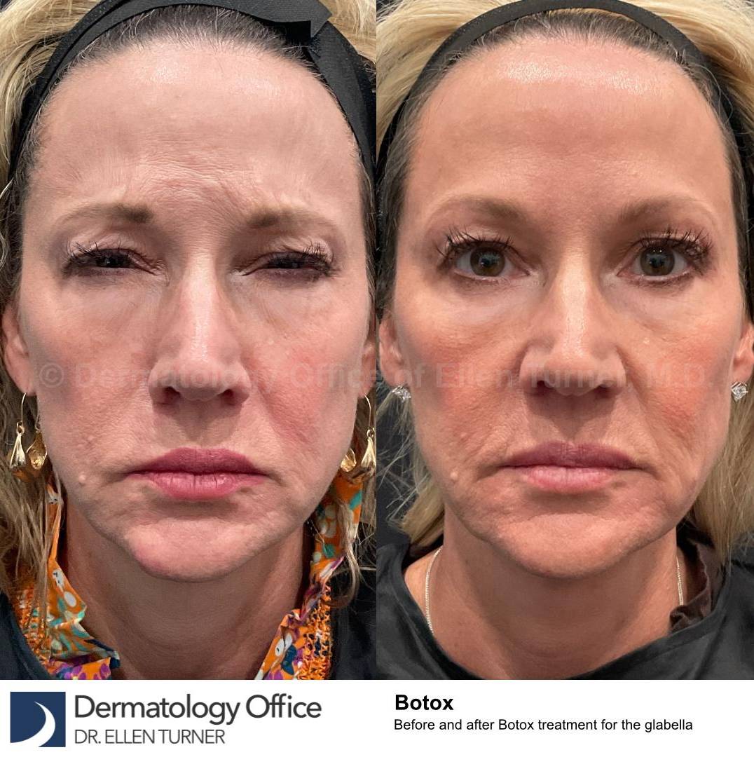 Botox Case 25 