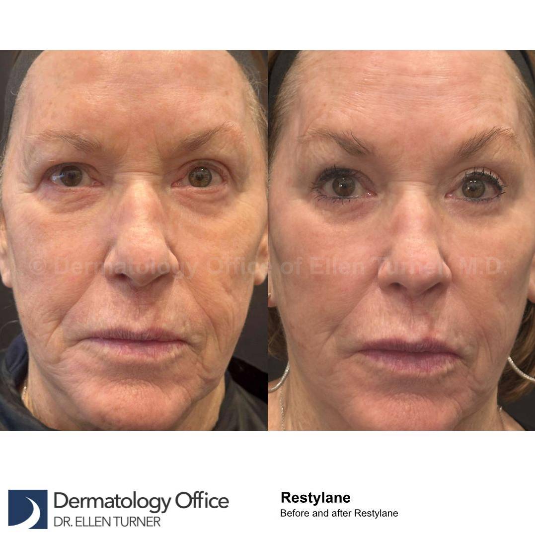 Restylane Before and After Case 24 