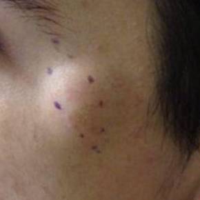 Cyst Removal Before and After Case 2 Before