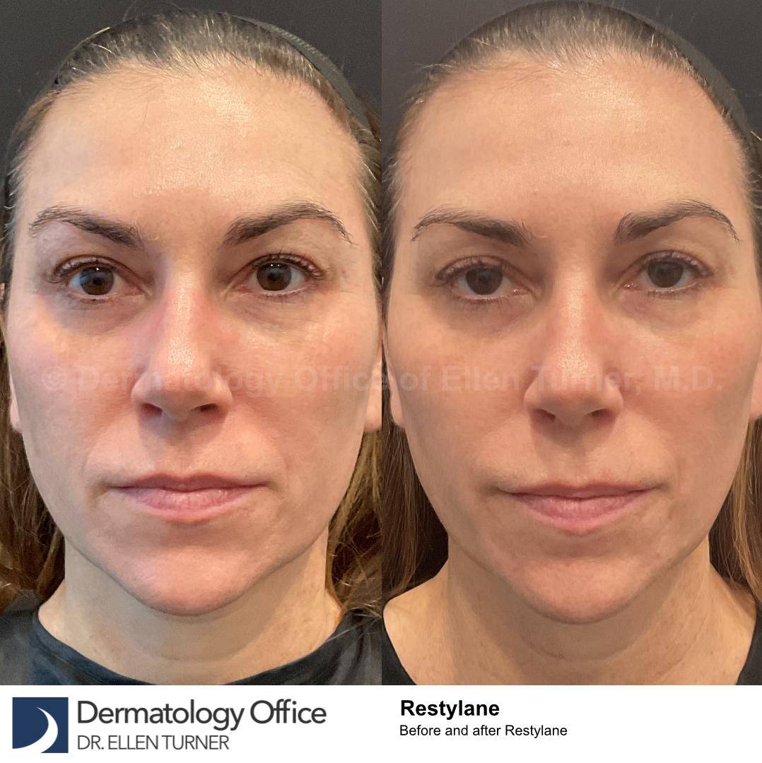 Restylane Before and After Case 25 