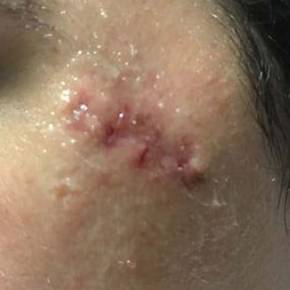 Cyst Removal Before and After Case 2 After
