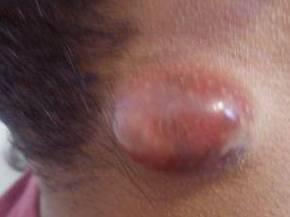 Cyst Removal Before and After Case 4 Before