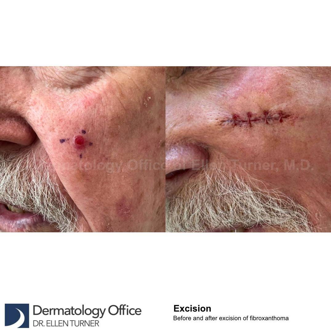 Cyst Removal Before and After Case-53 