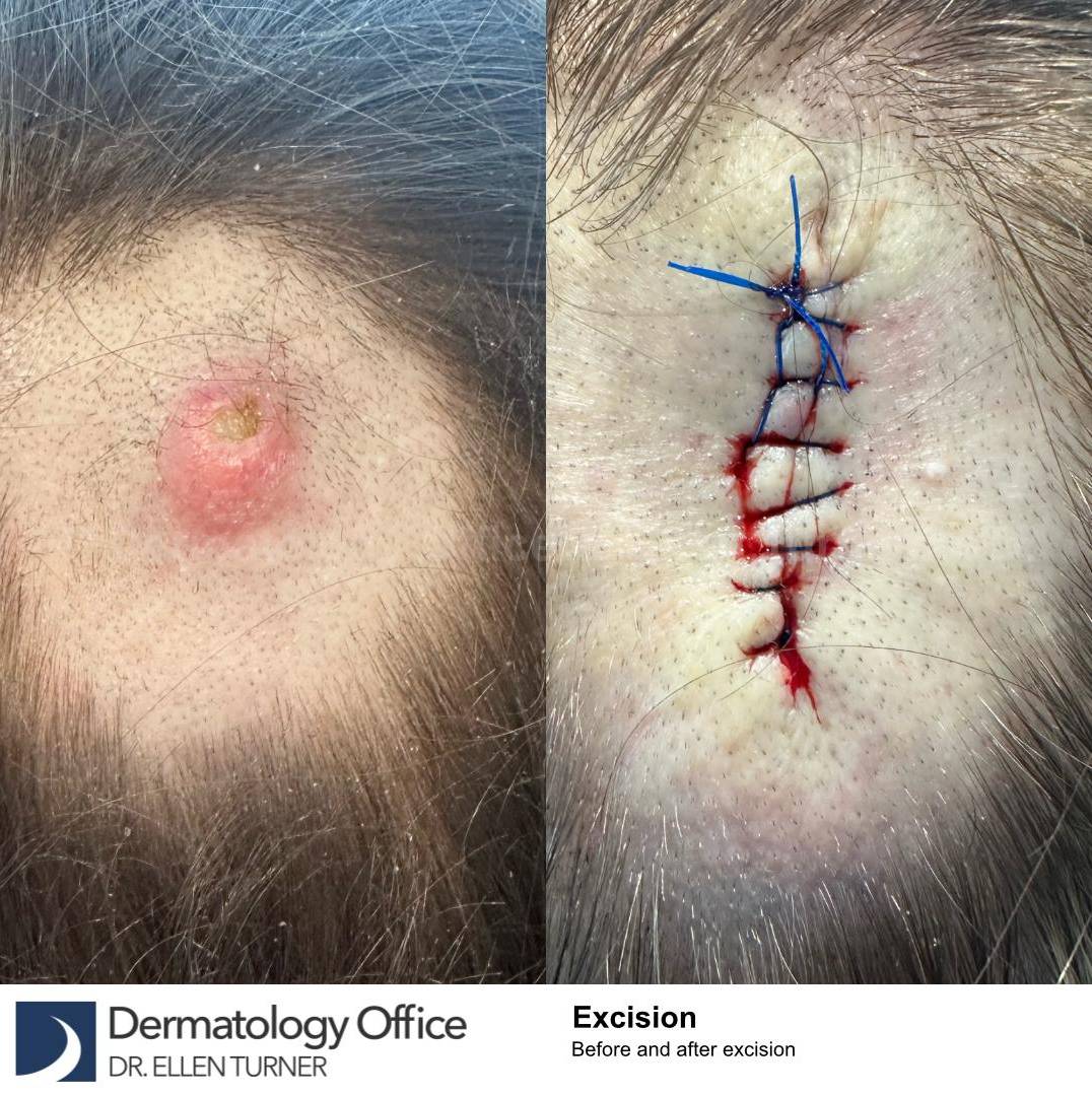 Skin Cancer (Excision) Case-94 