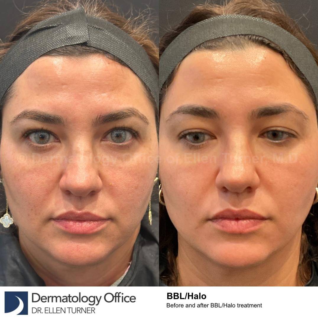 HALO™ Before and After Case 10 