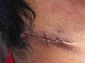 Cyst Removal Before and After Case 4 After