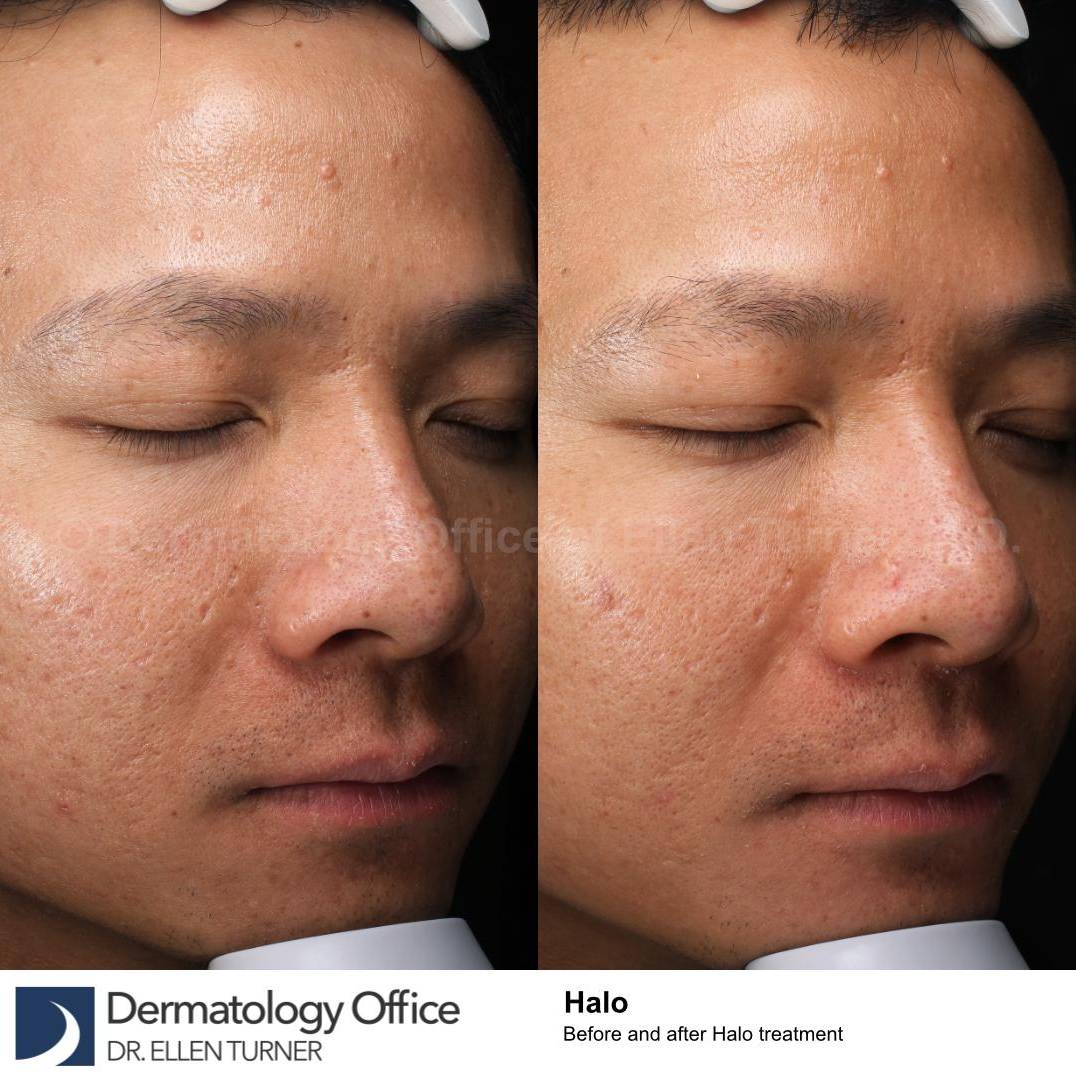 HALO™ Before and After Case 11 