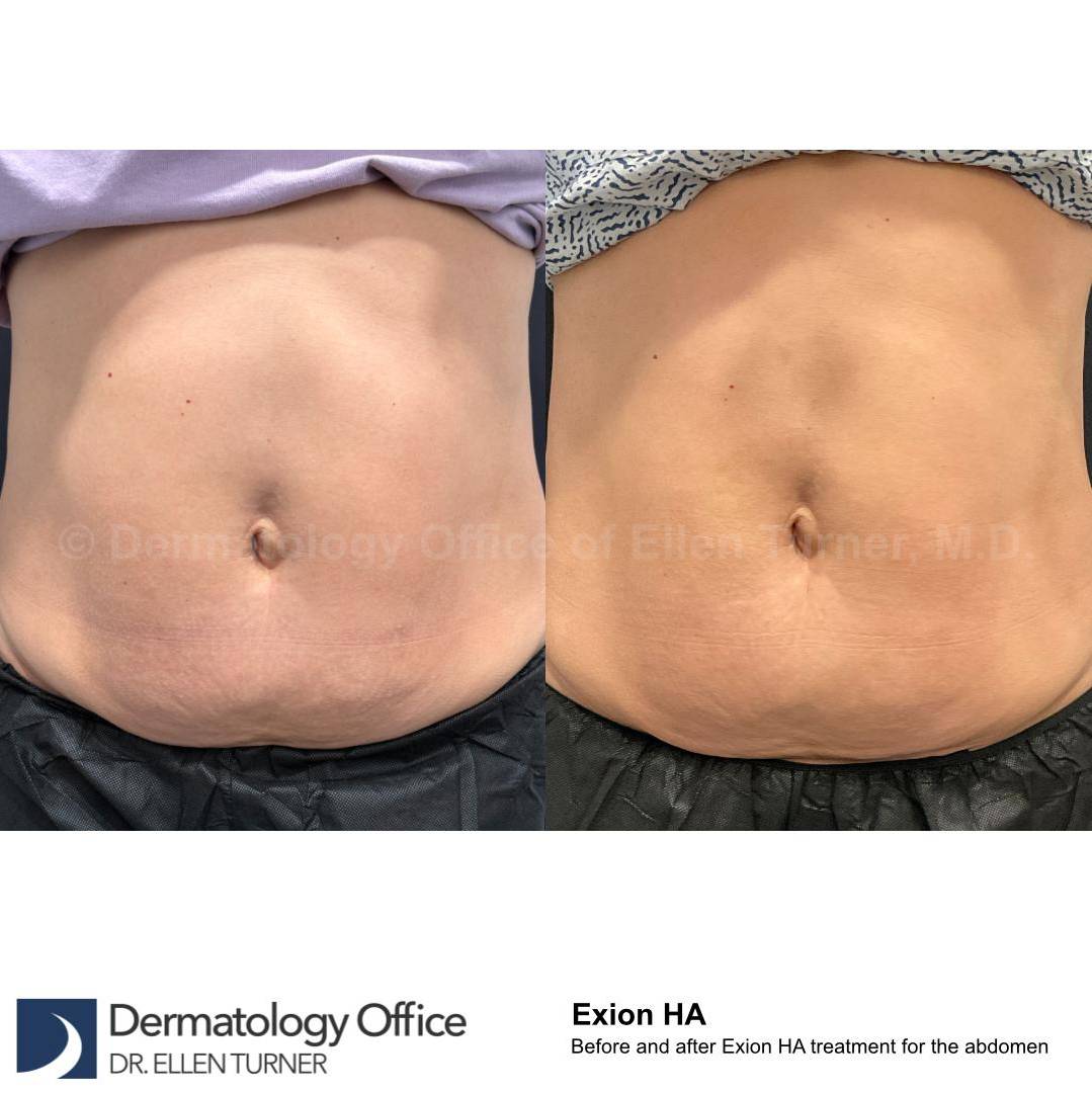 Exion HA Before and After Case 2 