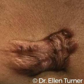 Keloids Before and After Case 1 Before