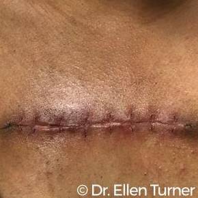 Keloids Before and After Case 1 After