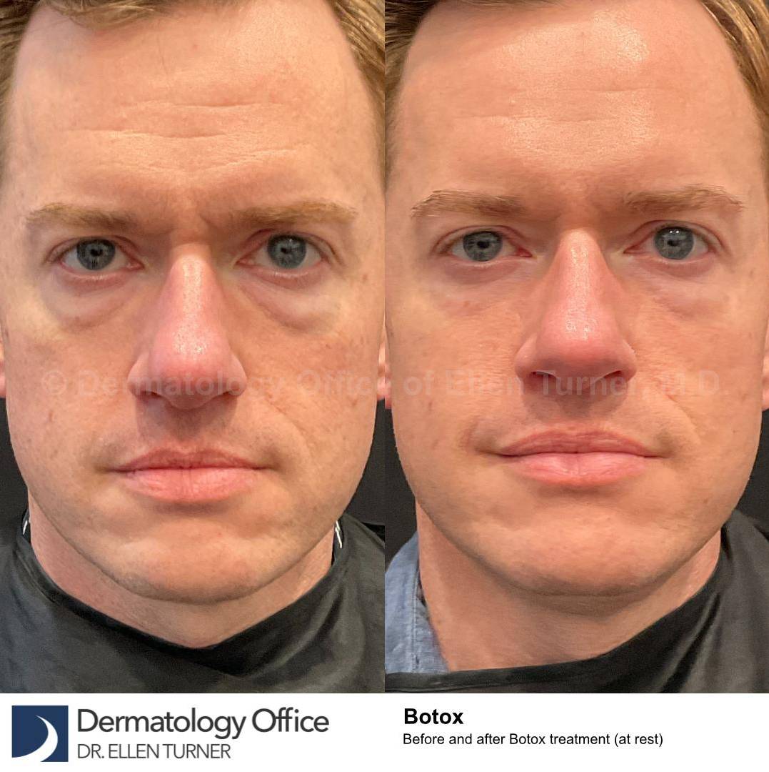 Botox Case 22 