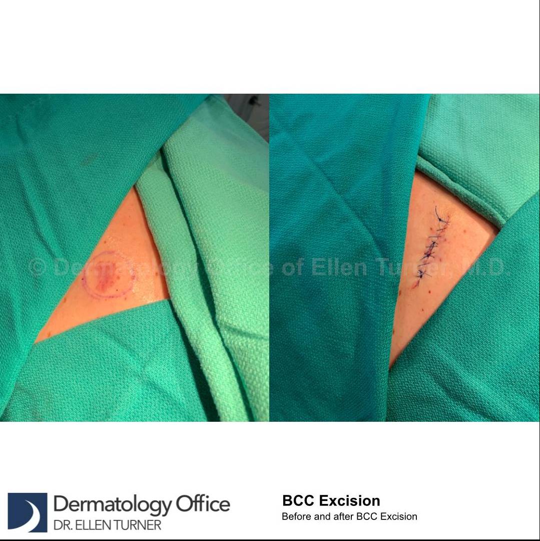 Skin Cancer (Excision) Case-95 