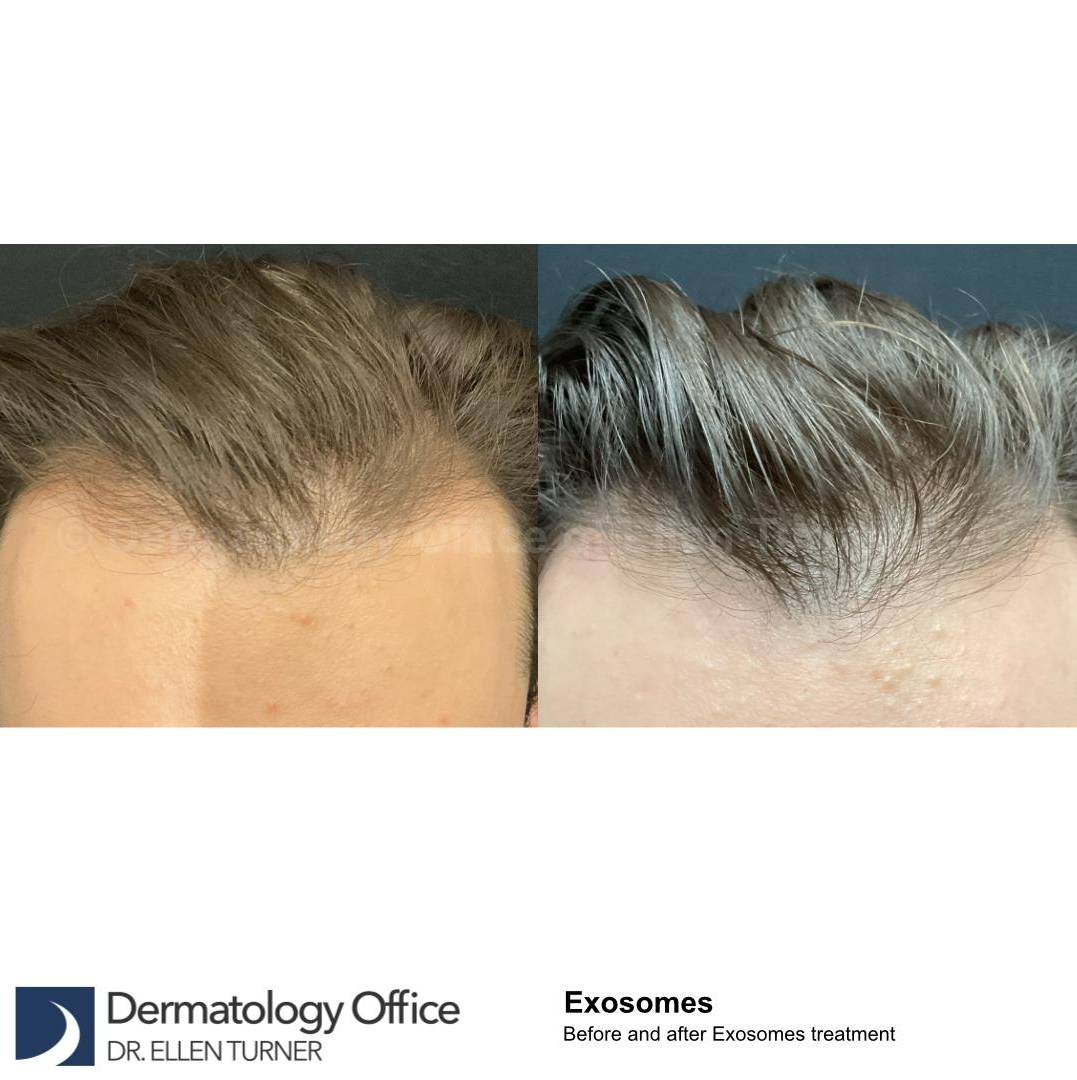 Hair Loss Before and After Case-16 