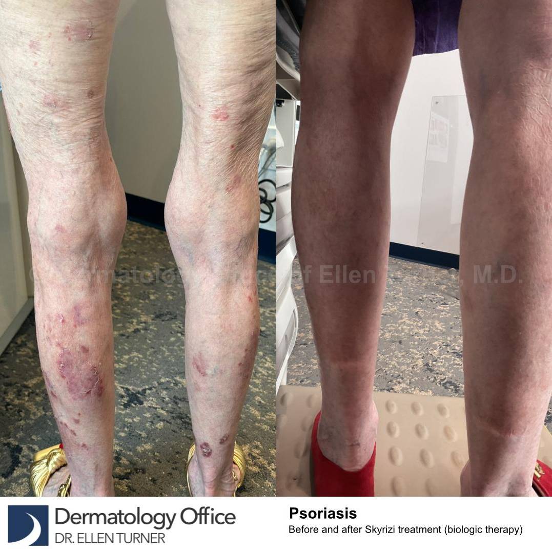Psoriasis Before and After Case 61 