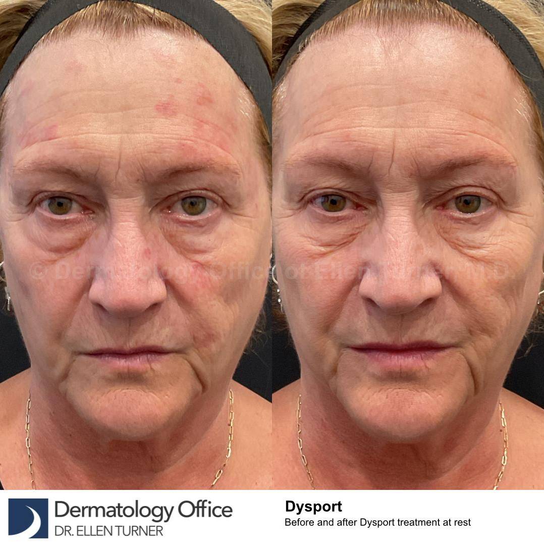 Dysport Before and after Case-6 