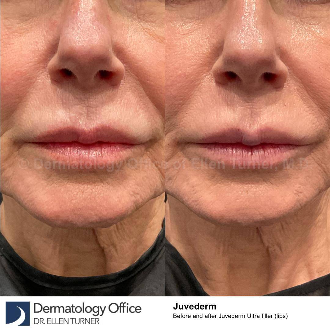 Juvederm (1 Syringe) Case-37 
