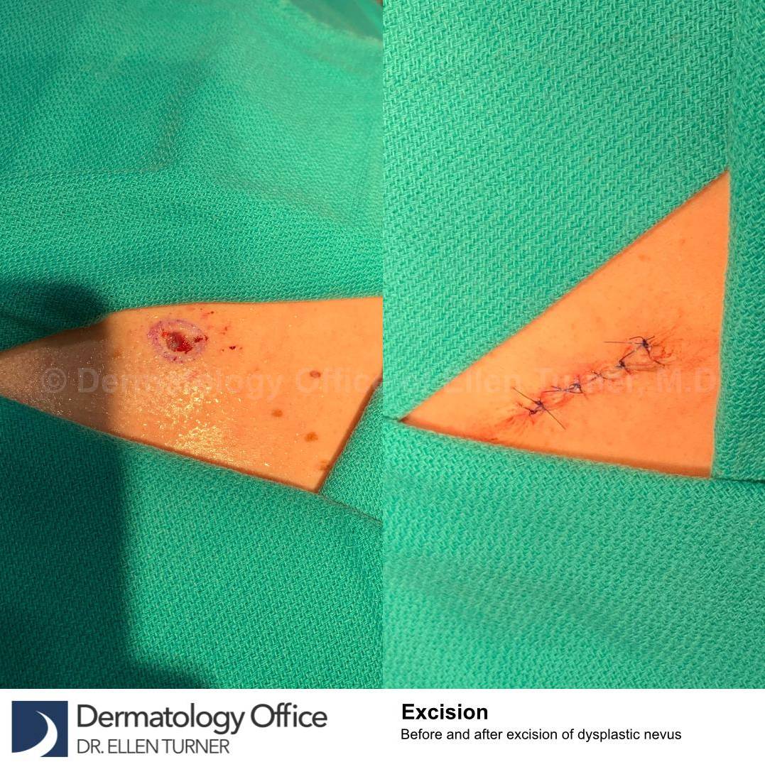 Skin Cancer (Excision) Case-96 