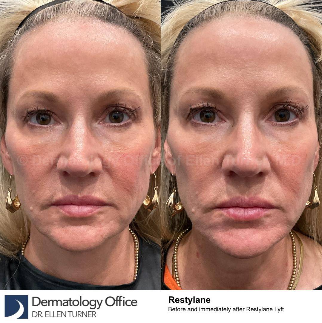 Restylane Before and After Case 29 