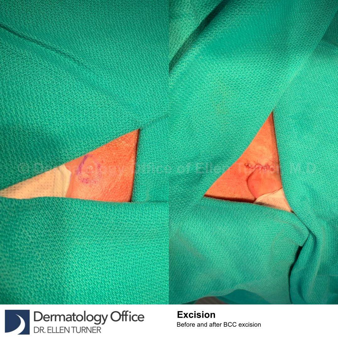 Skin Cancer (Excision) Case-98 