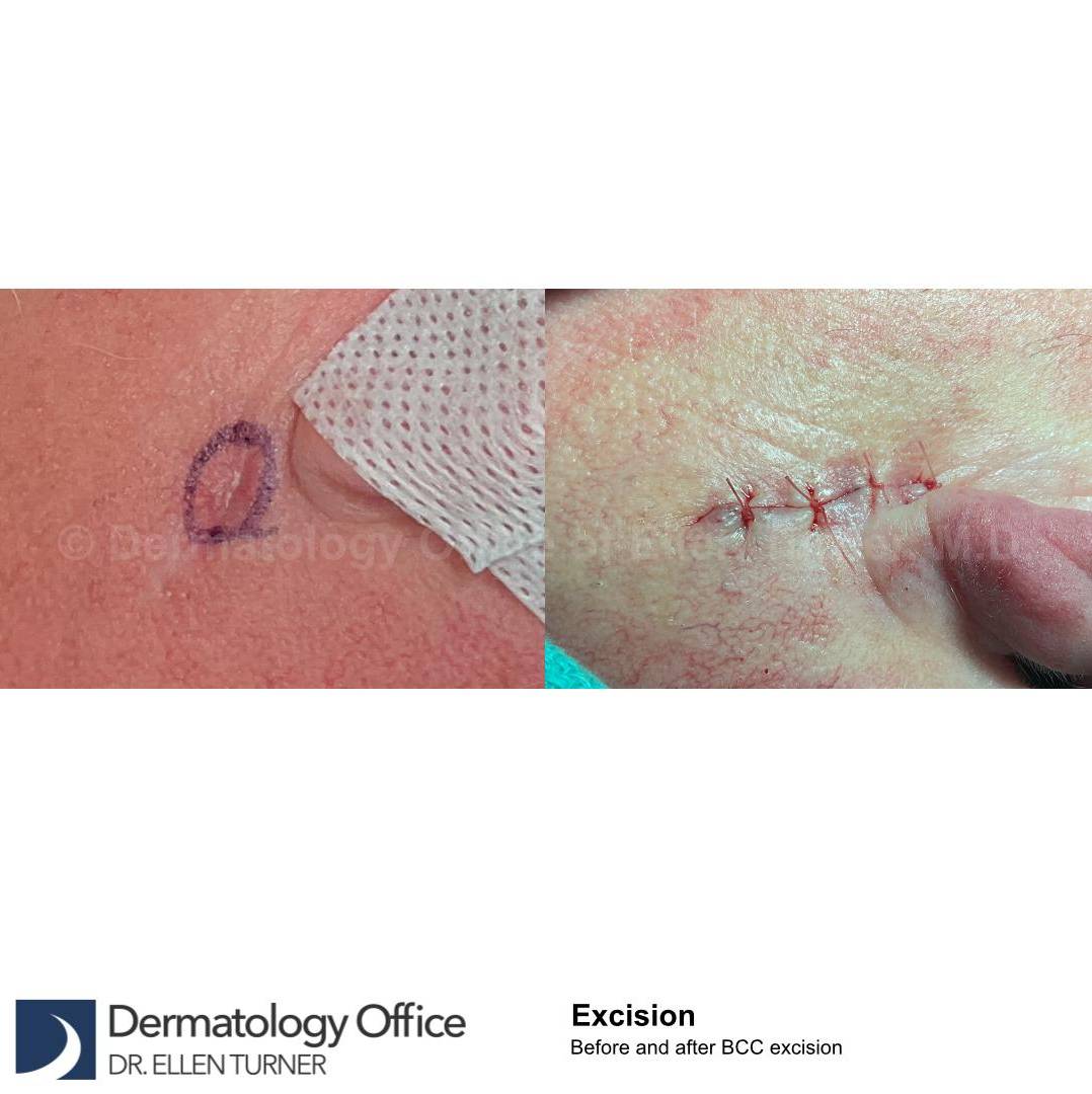 Skin Cancer (Excision) Case-99 