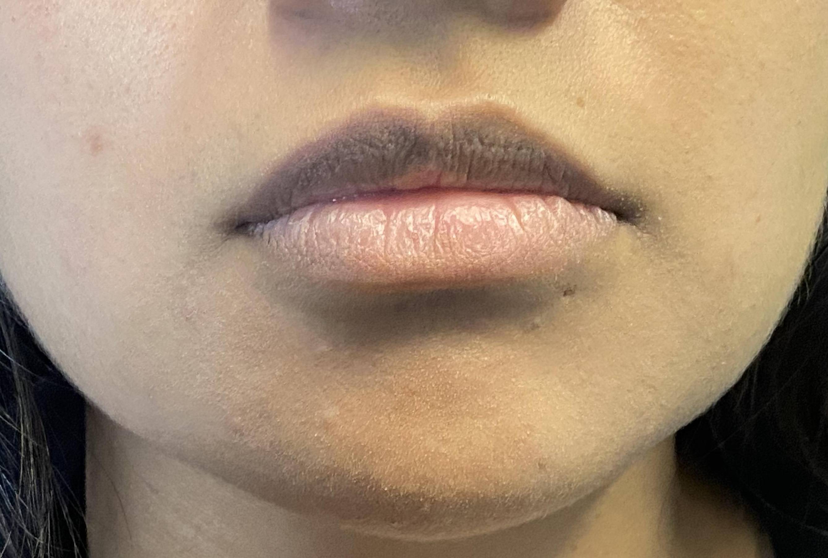 Teoxane RHA Filler (1 syringe RHA2) Case 2 Before