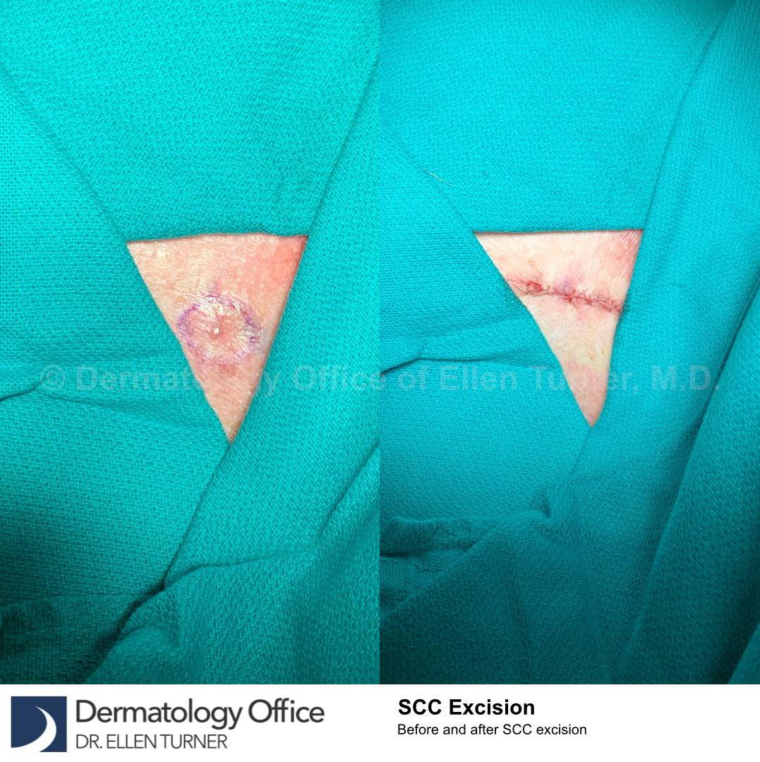 Skin Cancer (Excision) Case-100 