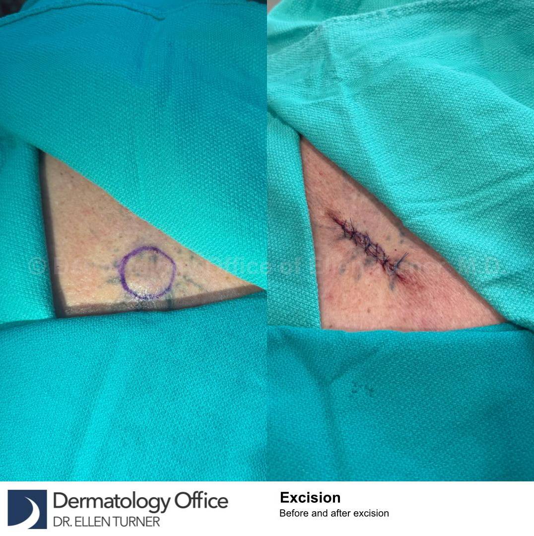 Skin Cancer (Excision) Case-101 
