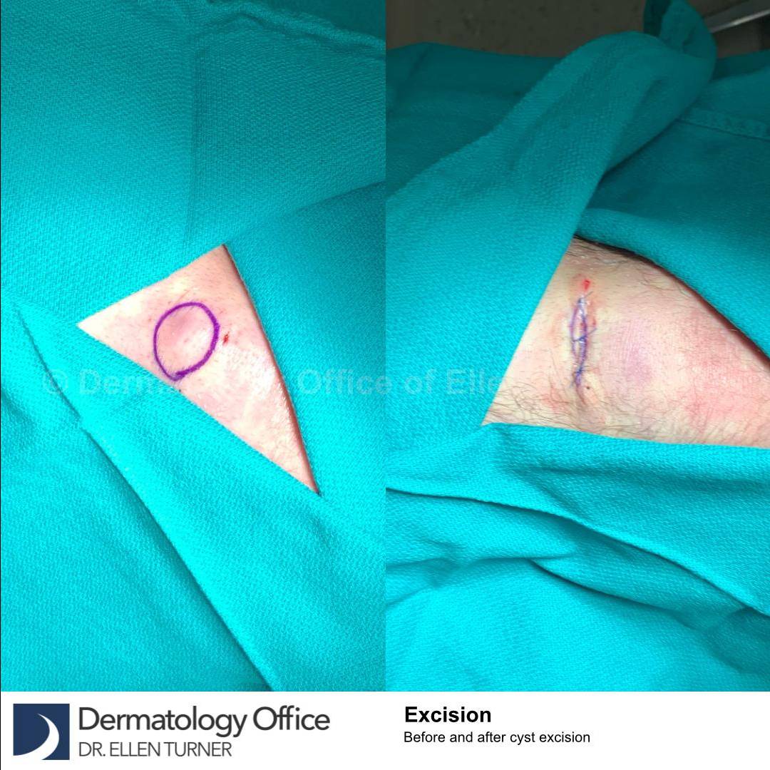 Cyst Removal Before and After Case-54 