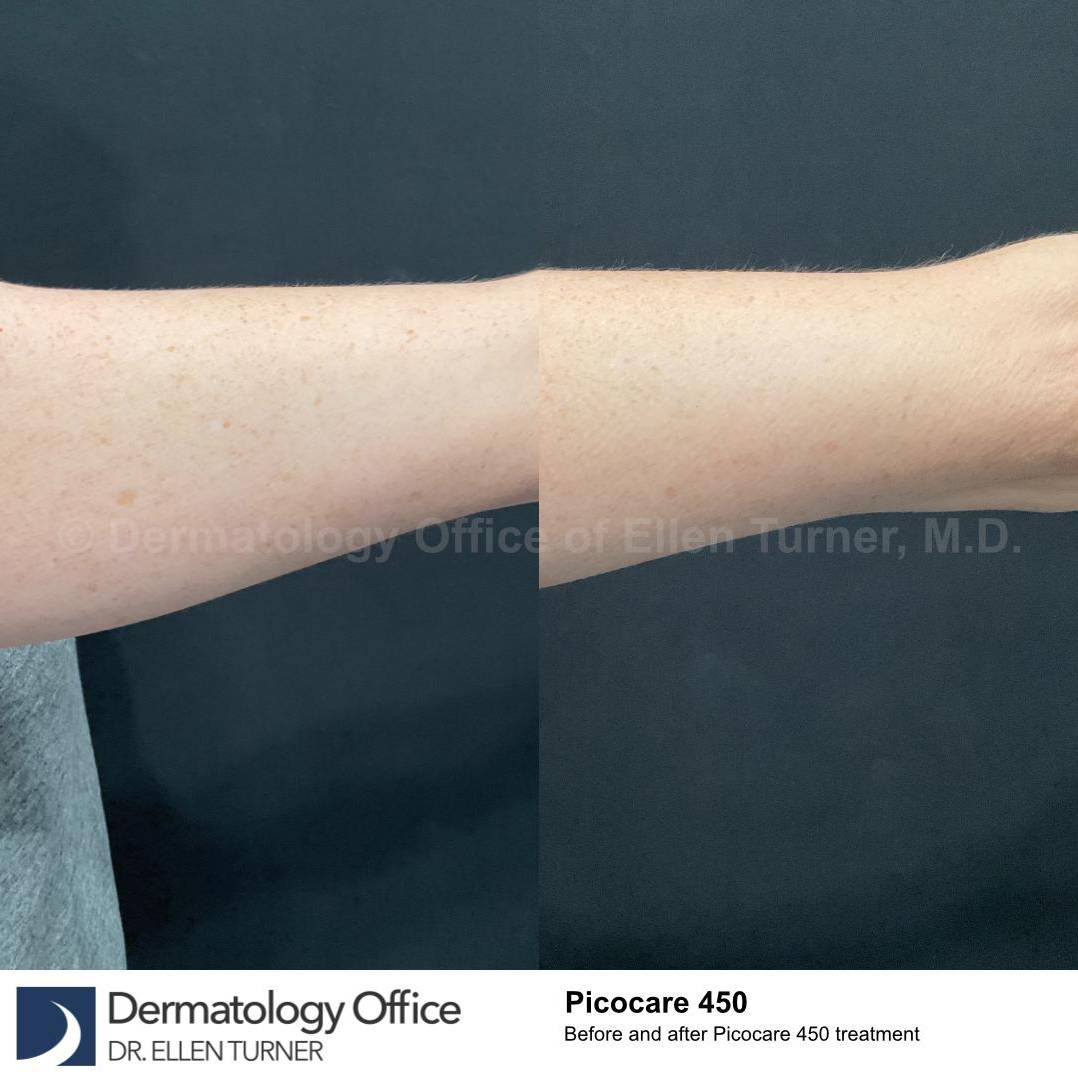 Picocare 450 Before and After Case-8 