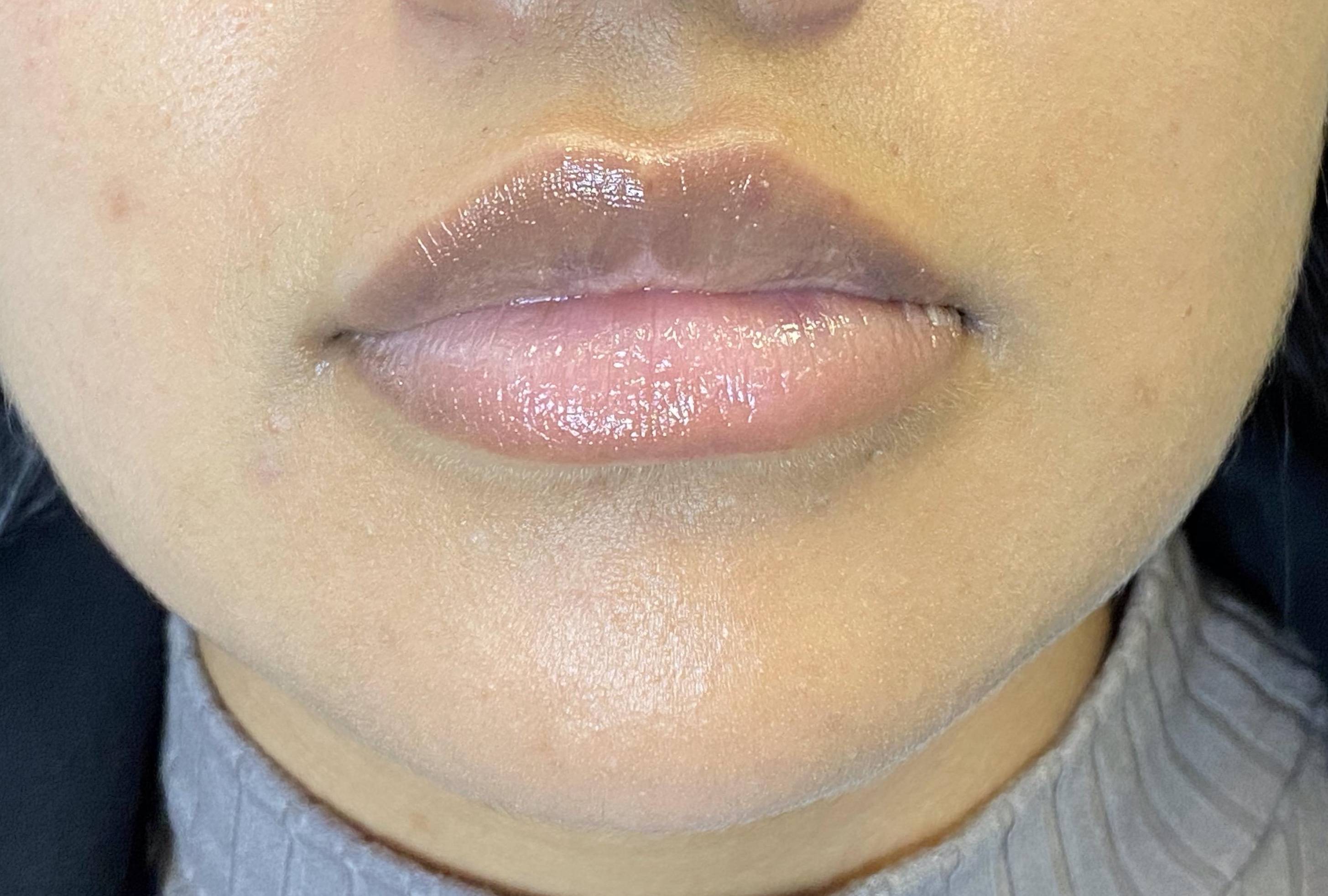 Teoxane RHA Filler (1 syringe RHA2) Case 2 After