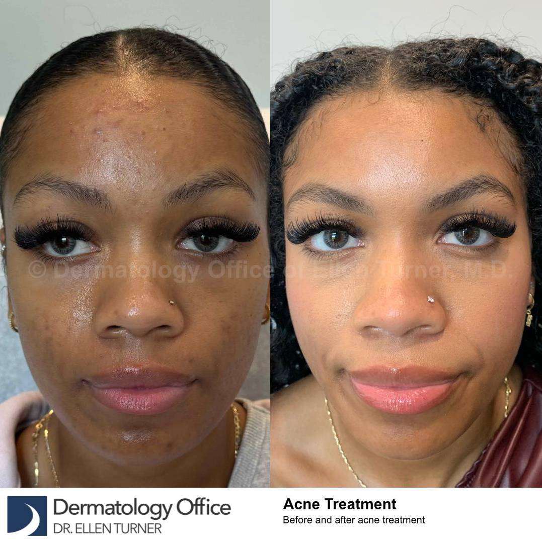 Acne Before and After Case-27 