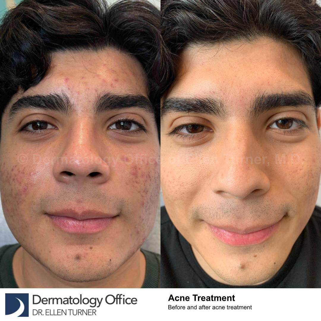 Acne Before and After Case-26 