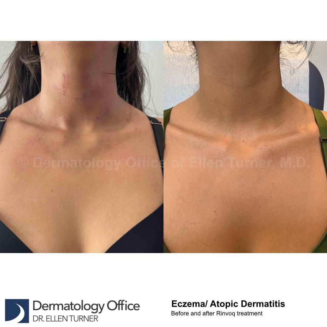 Eczema/Atopic Dermatitis Case 38 