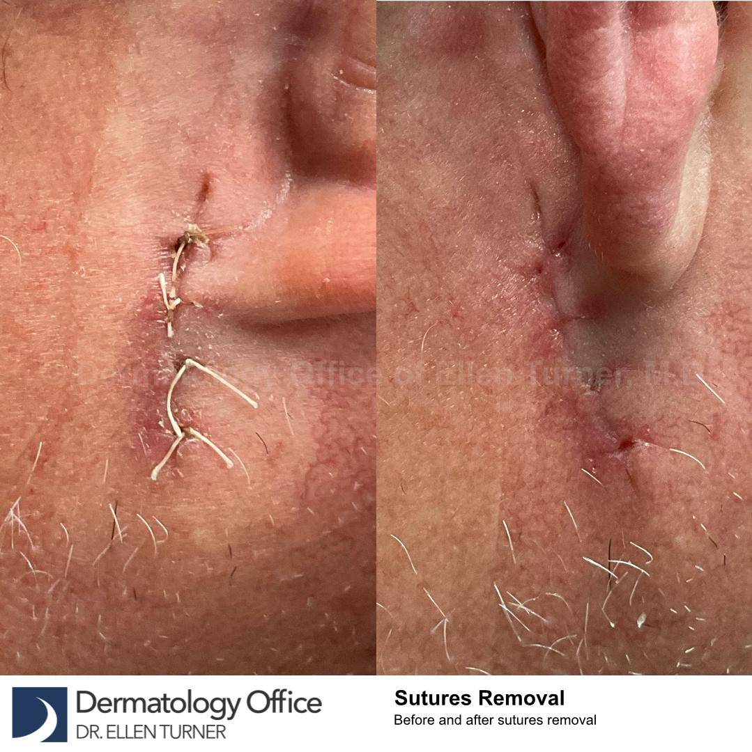 Skin Cancer (Sutures Removal) Case-103 