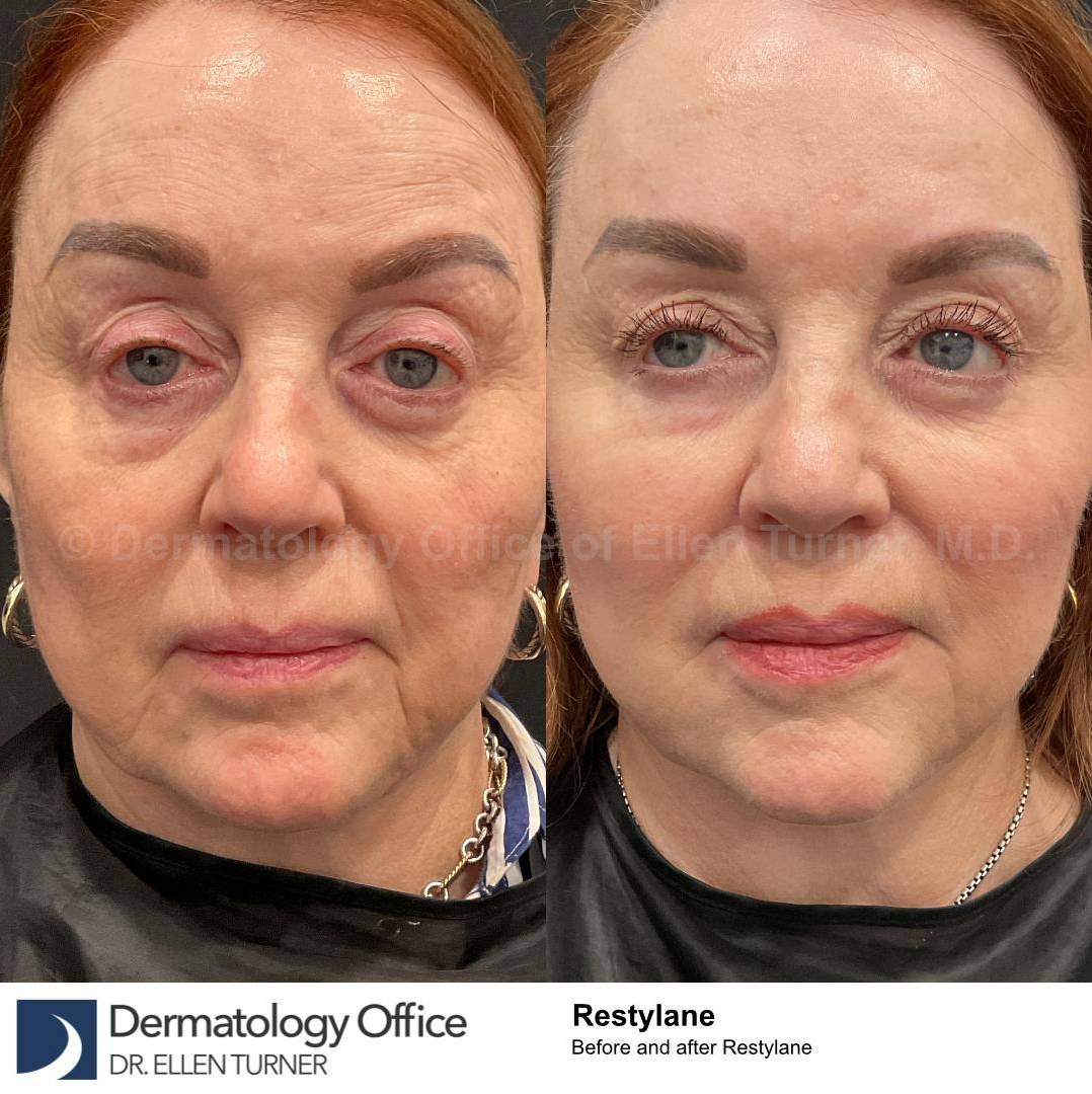 Restylane Before and After Case 30 