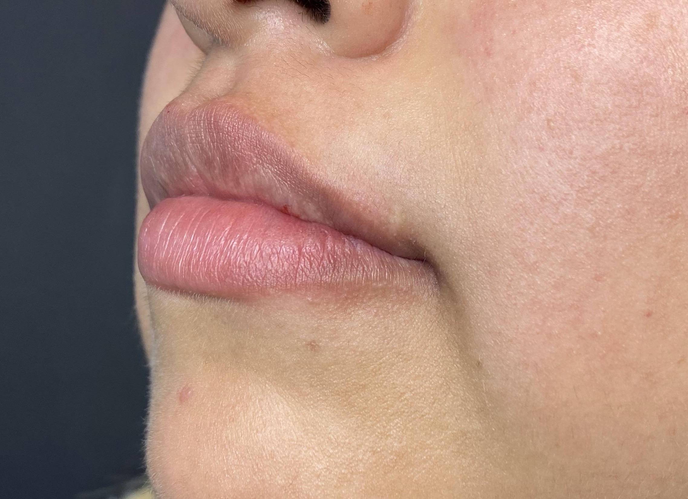 Teoxane RHA Filler (1 Syringe RHA2) Case 3 After