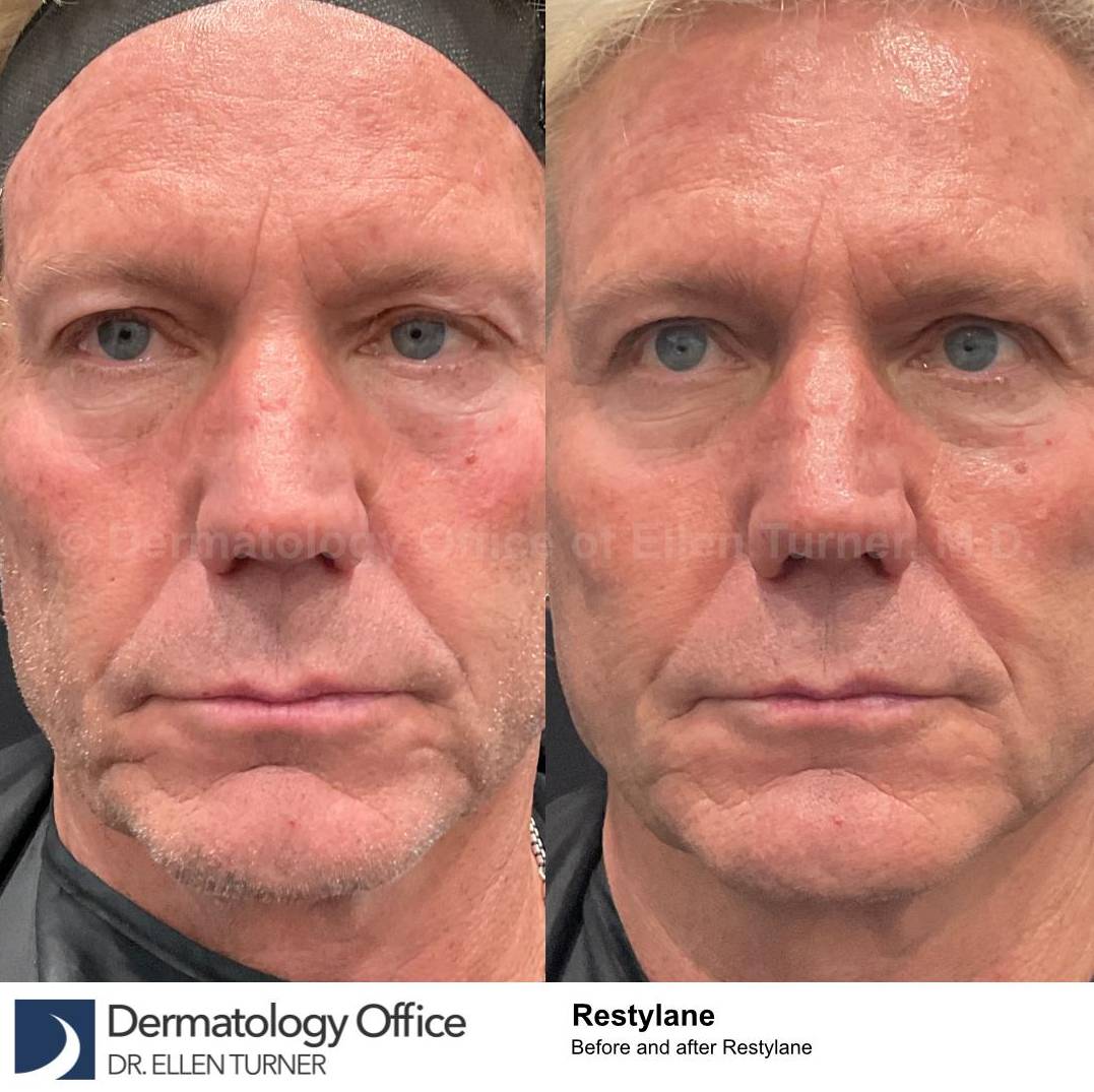 Restylane Before and After Case 31 