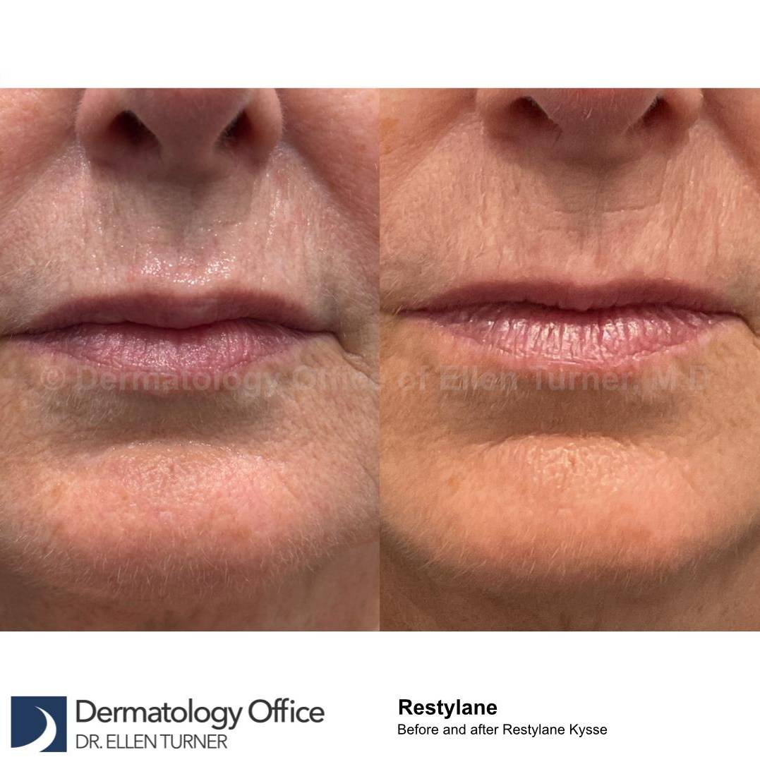 Restylane Before and After Case 32 