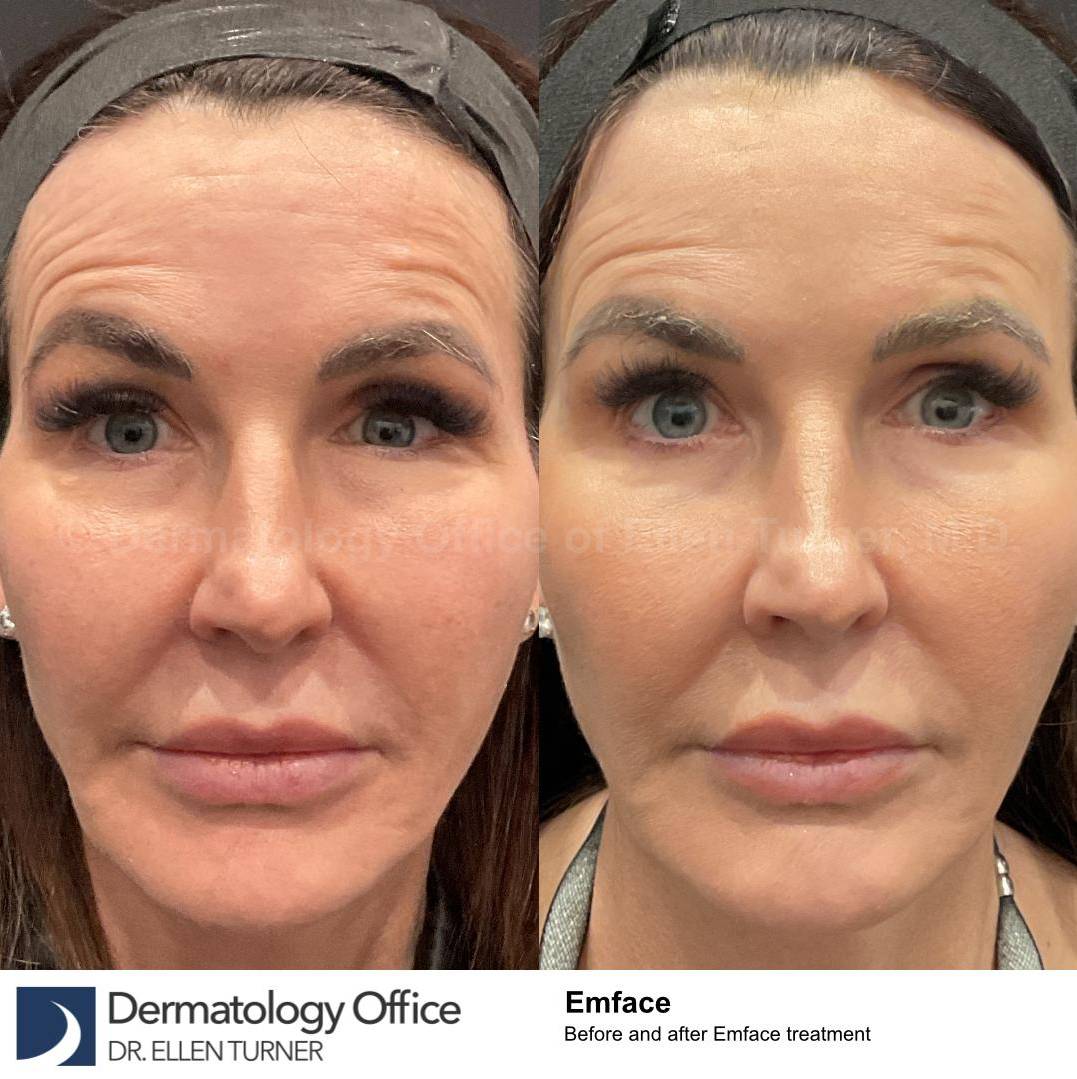 EMFACE Before and After-61 
