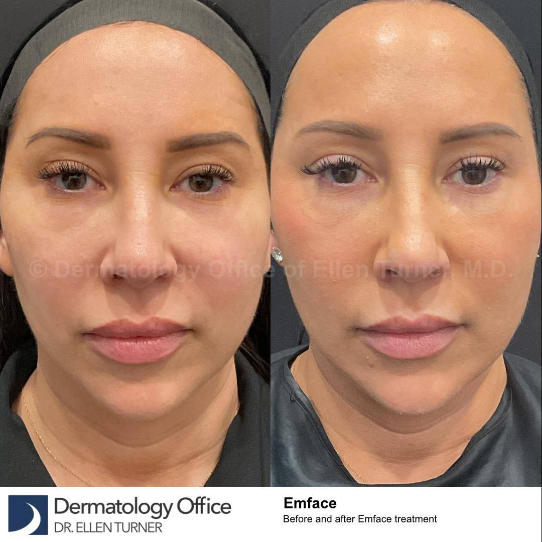 EMFACE Before and After-62 