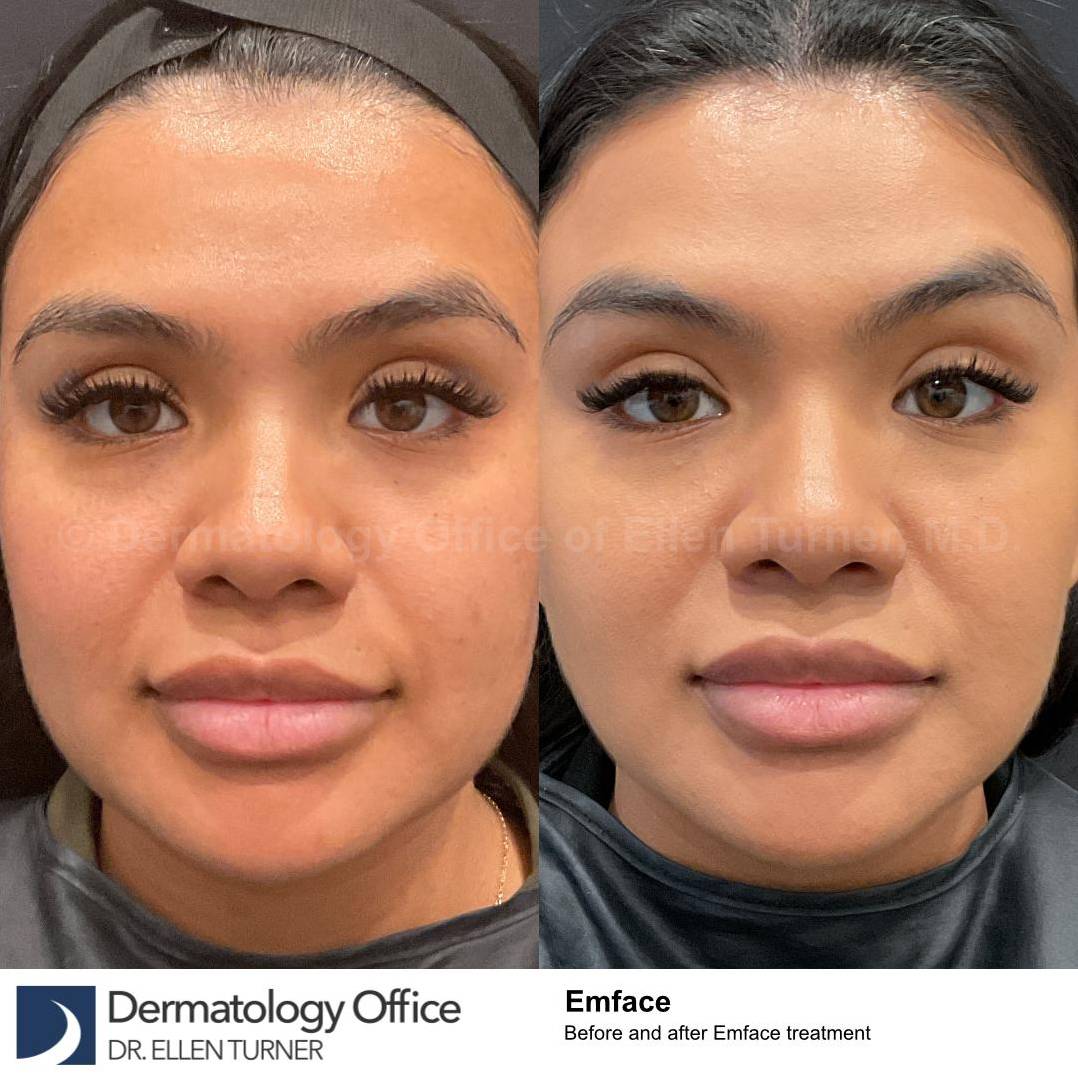 EMFACE Before and After-63  EMFACE Before and After-63