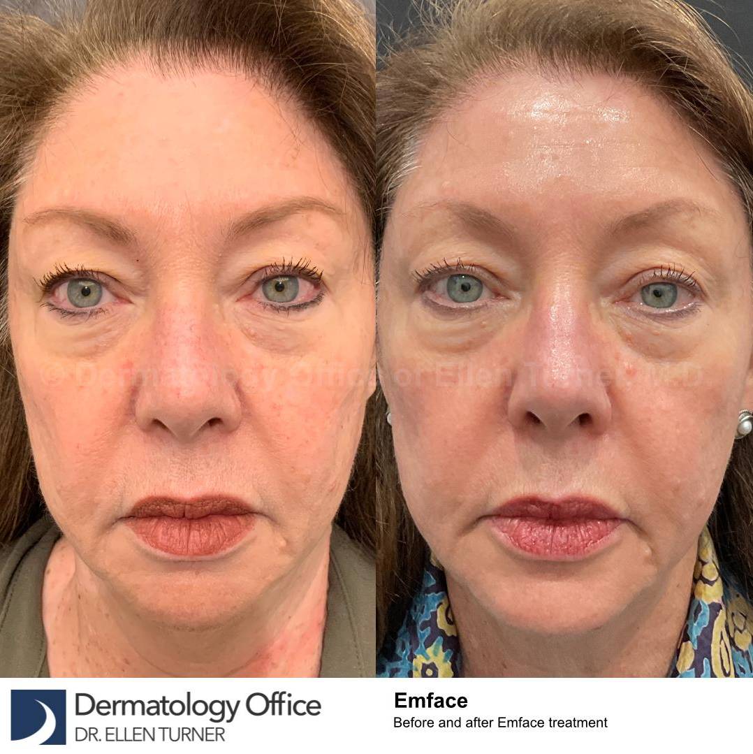 EMFACE Before and After-64  EMFACE Before and After-64